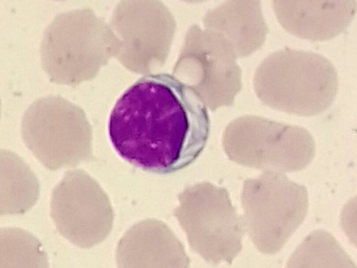 Мазок крови: лимфоцит с кристаллическими включениями в цитоплазме