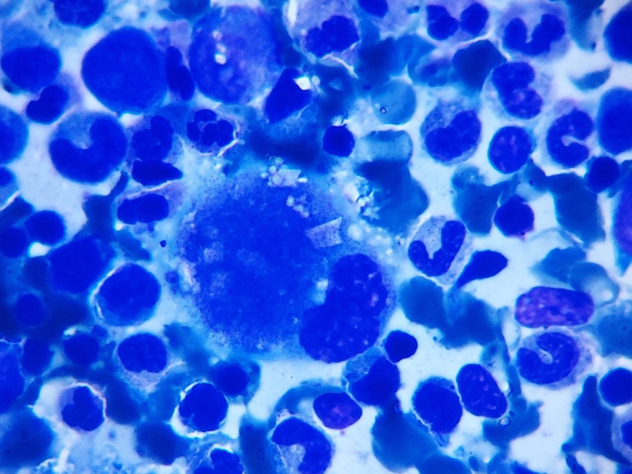 Crystals in Megakaryocytes: Morphology and Clinical Case