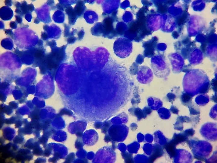 Bone marrow smear: megakaryocyte morphology in a child with thrombocytopenia