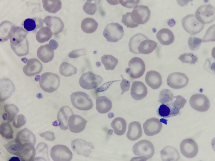 Мазок крови: нормобласты, тельца Жолли и выраженная полихромазия эритроцитов