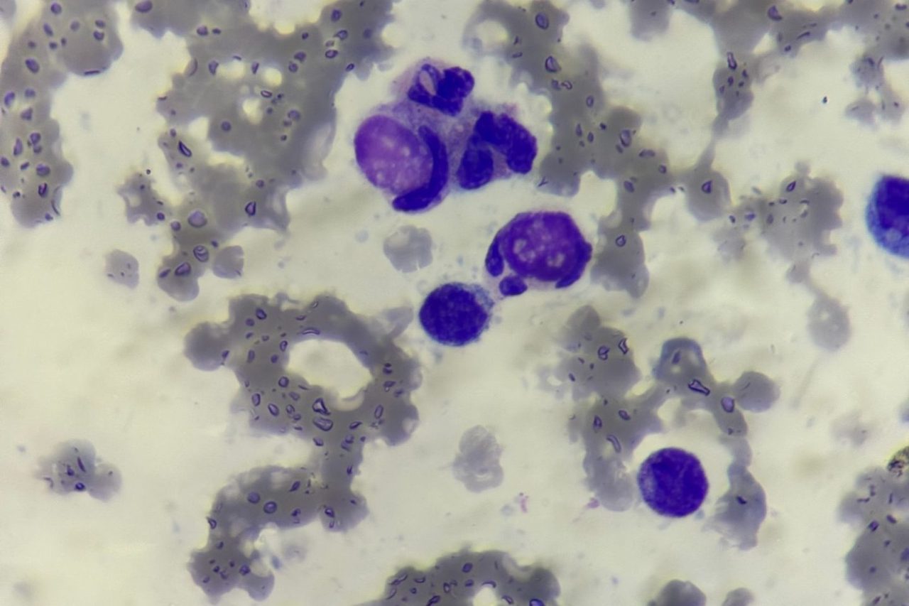 LE Cells in Peripheral Blood Smears: Morphology and Diagnostics