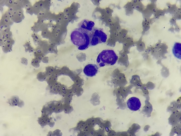 Blood smear: LE cell with a large phagocytosed hematoxylin body