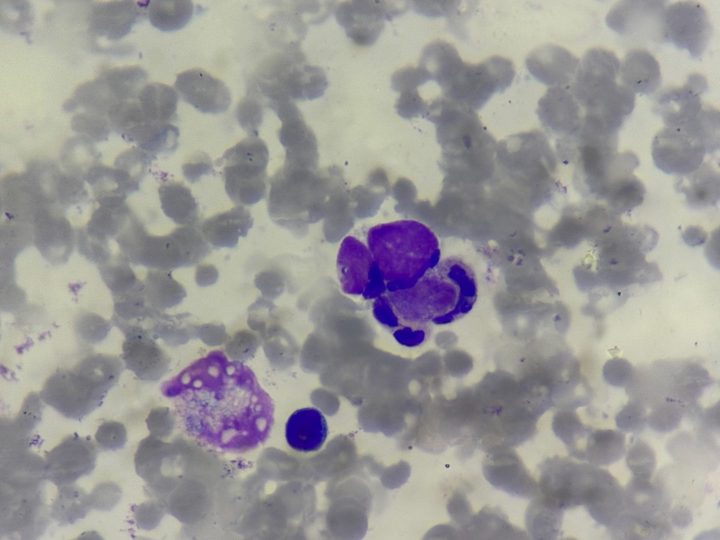 Blood smear: neutrophil with an absorbed homogeneous nuclear mass in the cytoplasm