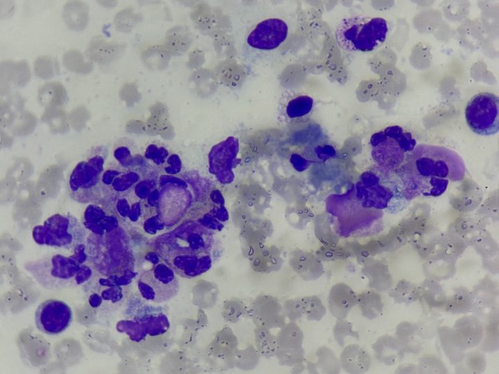 Blood smear: rosette of neutrophils around free nuclear detritus and an LE cell