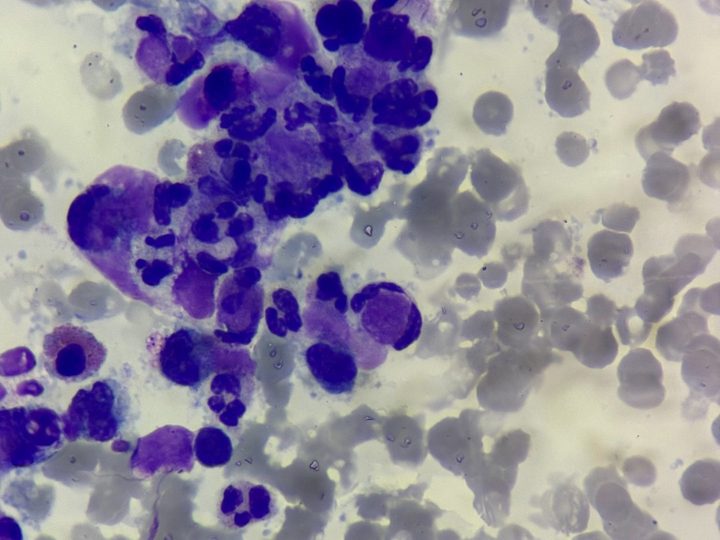 Blood smear: large conglomerate of neutrophils in the process of LE cell formation