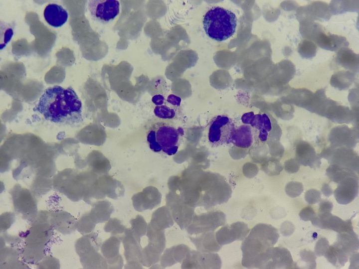 Blood smear: classic LE cells with displaced granulocyte nuclear segments