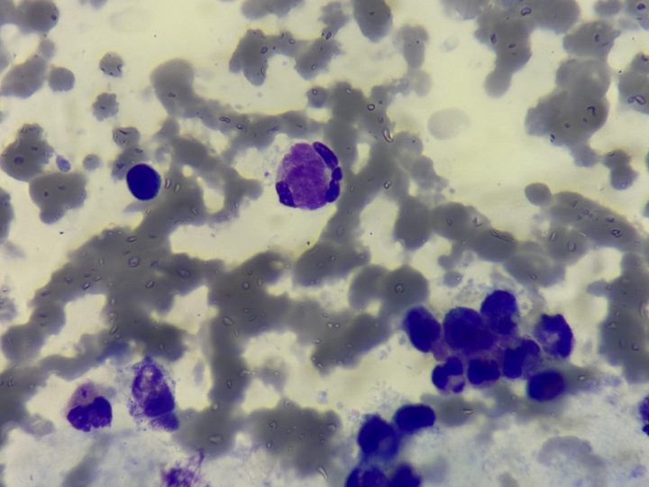 Blood smear: mature LE cell in the center of the field of view and a leukocyte aggregate