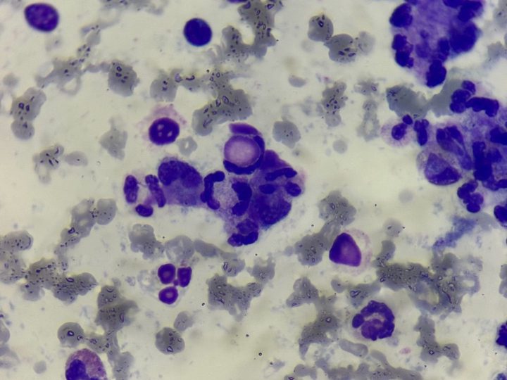 Blood smear: neutrophil rosette formation phenomenon and phagocytosis of an altered nucleus