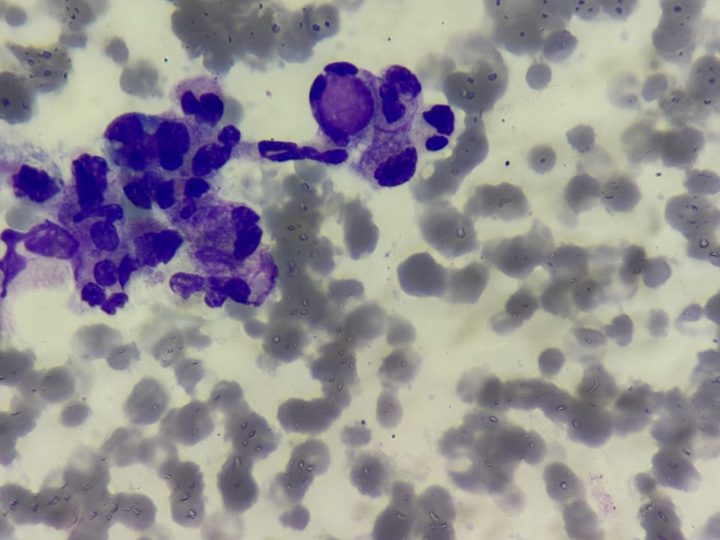 Blood smear: LE cell with a characteristic basophilic inclusion of a phagocytosed nucleus