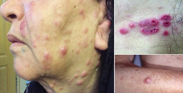 Leukemia cutis: специфические поражения кожи при лейкозе