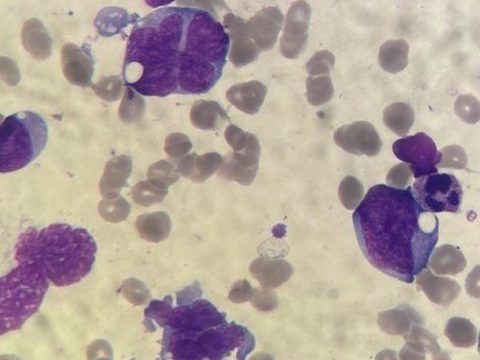 Мазок костного мозга: многолопастный атипичный бласт с глубокой вырезкой ядра