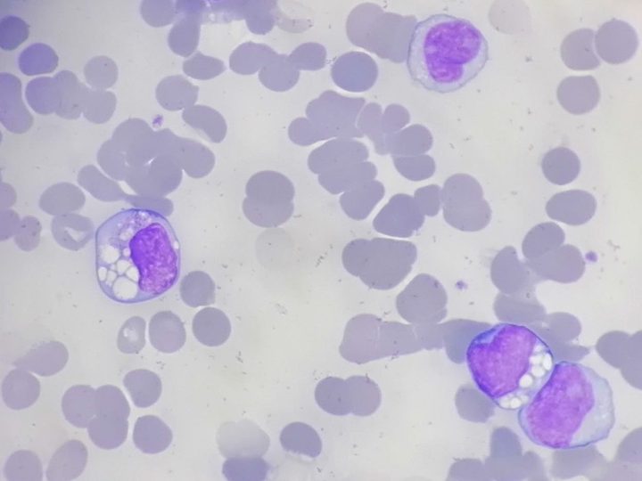 Мазок крови: аномальные лимфоциты с крупными вакуолями в цитоплазме