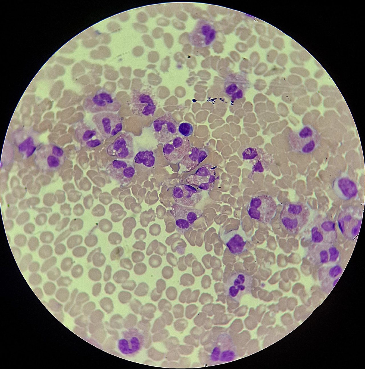 Eosinophilic Leukemoid Reaction: Blood Smear Morphology