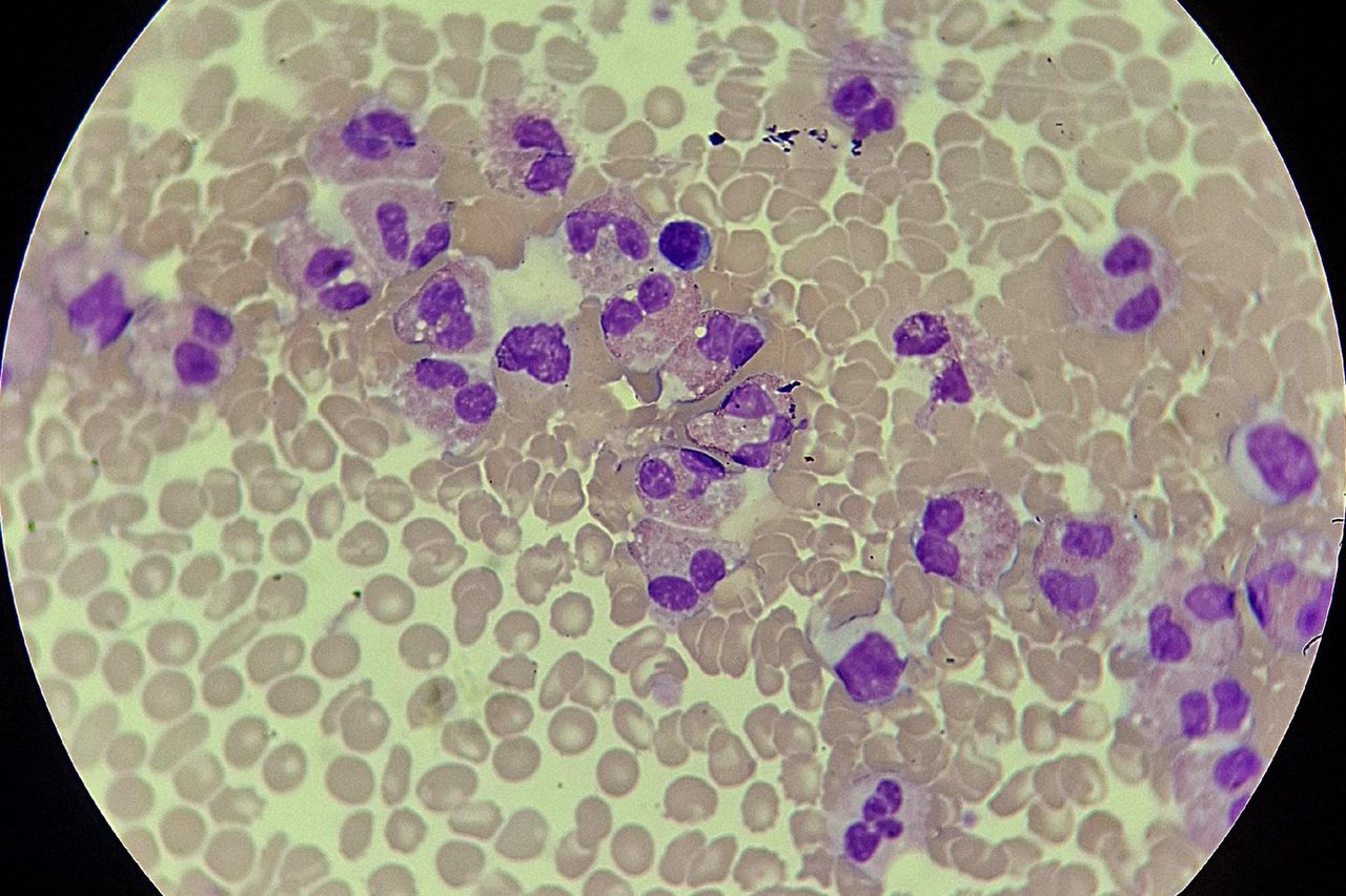 Eosinophilic Leukemoid Reaction: Blood Smear Morphology