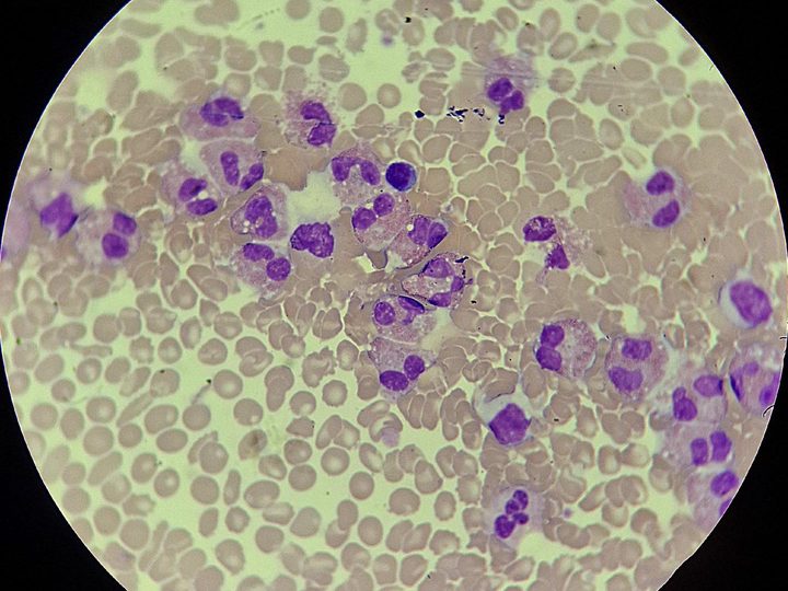 Blood smear, sharp predominance of eosinophils in the microscope field of view