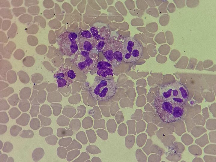 Blood smear, cluster of eosinophils with characteristic oxyphilic granularity