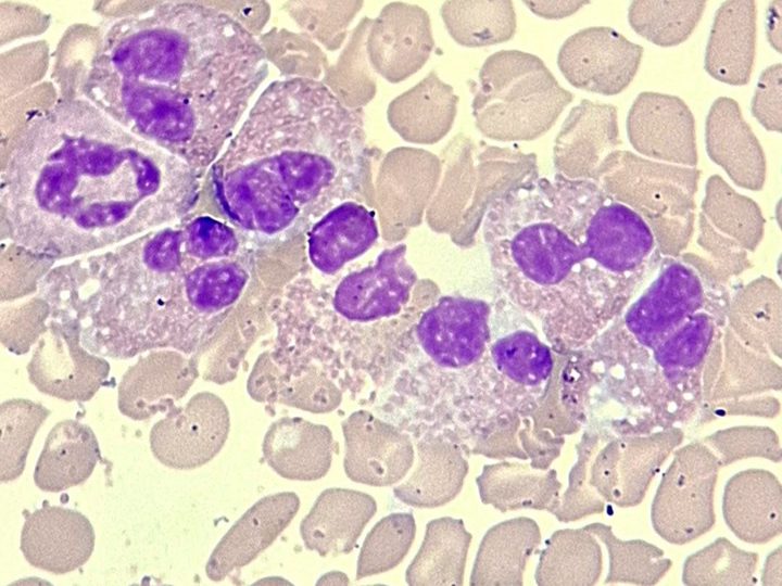 Blood smear, morphology of segmented eosinophils at high magnification