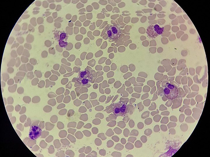 Blood smear, eosinophils in the field of view in pronounced eosinophilia