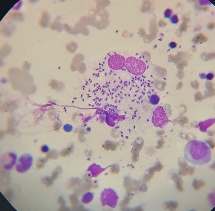 Bone marrow smear: accumulation of Leishmania amastigotes in the field of view