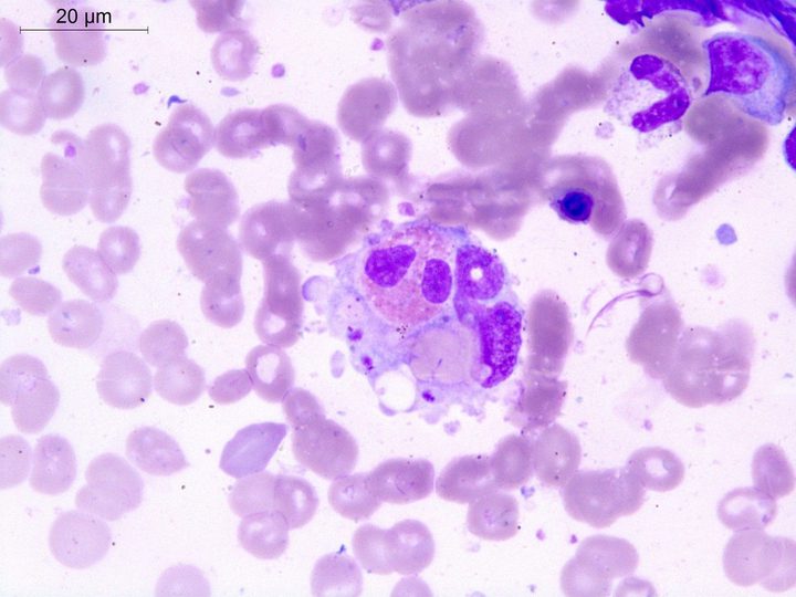 Bone marrow aspirate smear: macrophage, phagocytosing an eosinophil, erythrocyte, and Leishmania