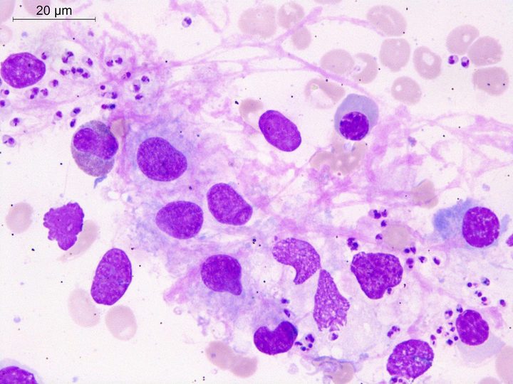 Bone marrow aspirate smear: cluster of stromal cells and Leishmania amastigotes