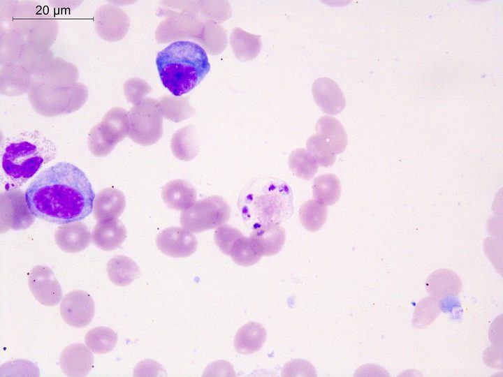 Bone marrow aspirate smear: degenerating cell with Leishmania amastigotes