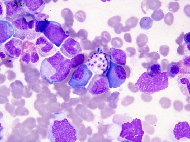Bone marrow aspirate smear: clear cell with numerous amastigotes among myelokaryocytes