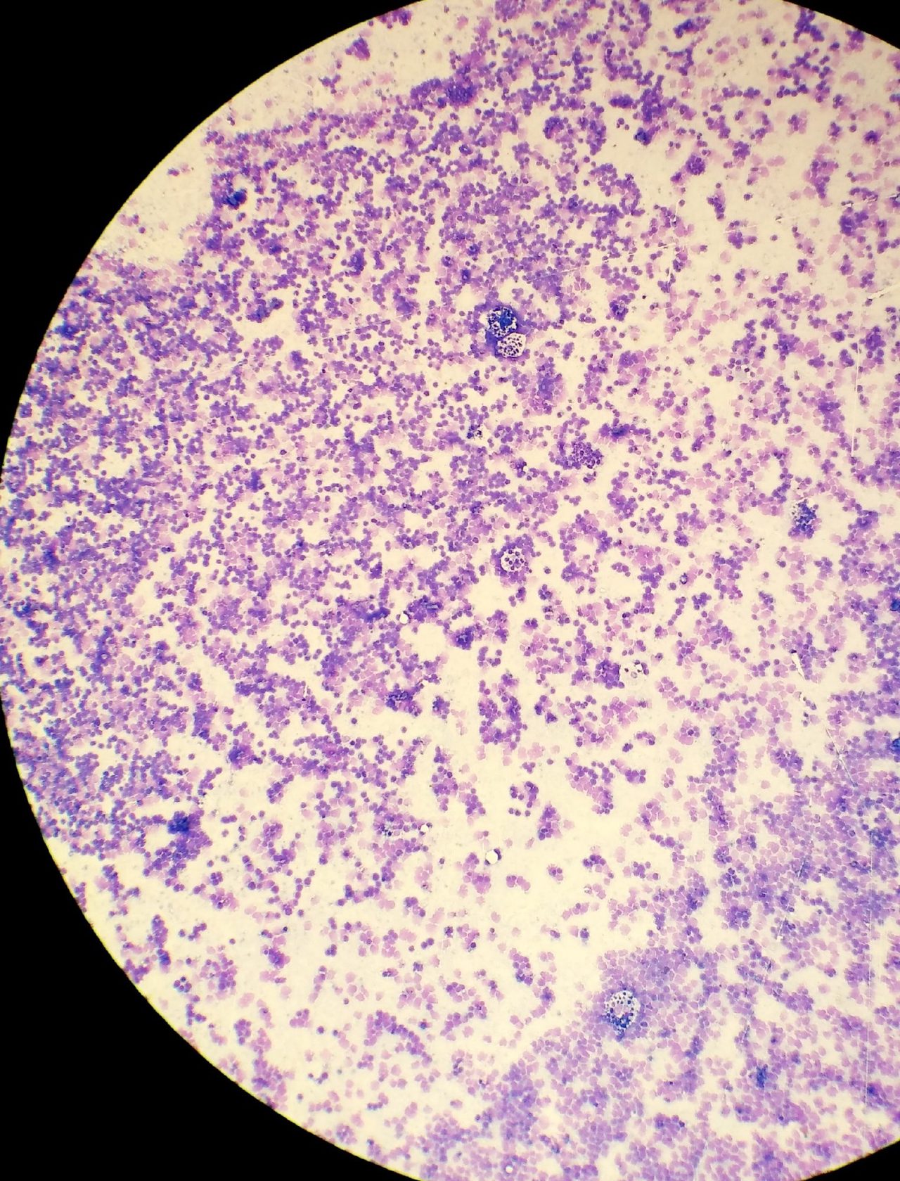 Burkitt Lymphoma: Cytological Features and Immunophenotype