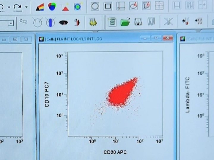Графики проточной цитометрии ликвора с экспрессией CD20, CD10 и легких цепей лямбда