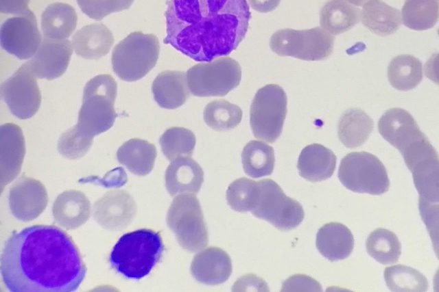 Marginal Zone Lymphoma: Atypical Lymphocytes in Blood Smear
