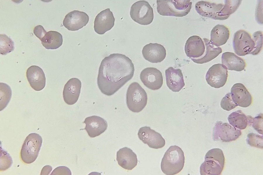 Macrocytosis and Red Blood Cell Morphology in B12 Deficiency