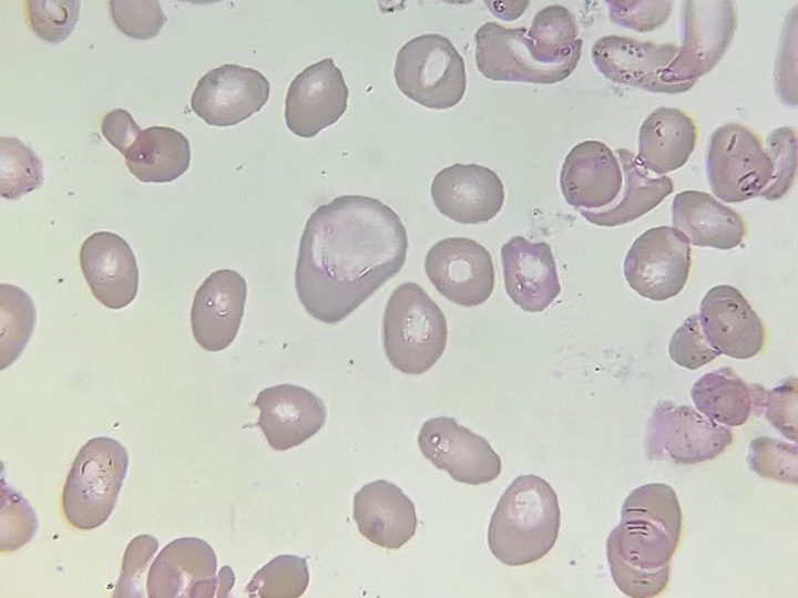 Blood smear: pronounced anisocytosis and a giant macro-ovalocyte in the center of the field of view