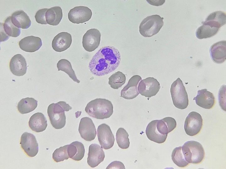 Blood smear: segmented neutrophil and macrocytes comparable in size to it