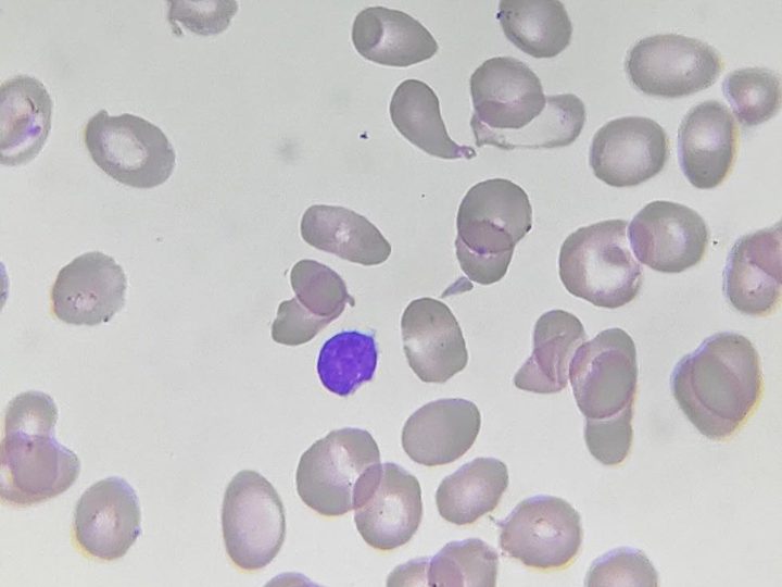 Blood smear: comparison of lymphocyte size and large deformed red blood cells
