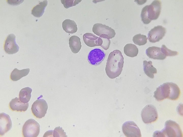 Blood smear: lymphocyte surrounded by macro-ovalocytes with MCV 130 fL