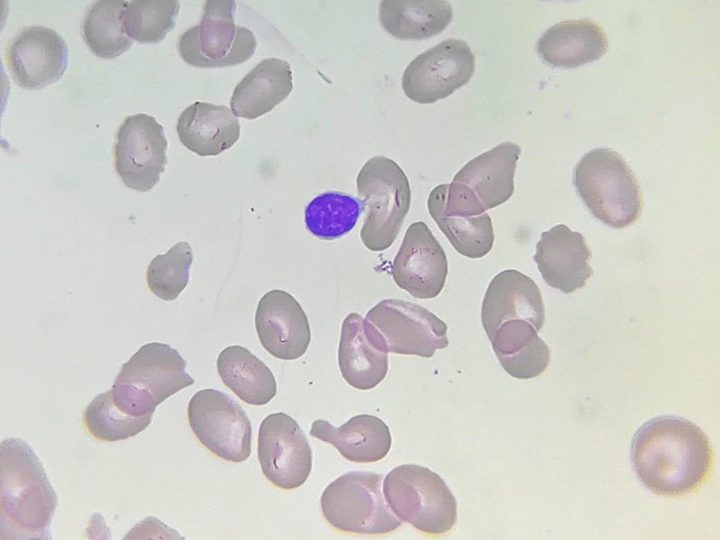 Blood smear: lymphocyte, poikilocytosis, and pronounced red blood cell macrocytosis