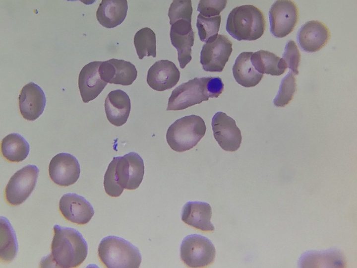 Blood smear: nucleated red blood cell (normoblast) among poikilocytes