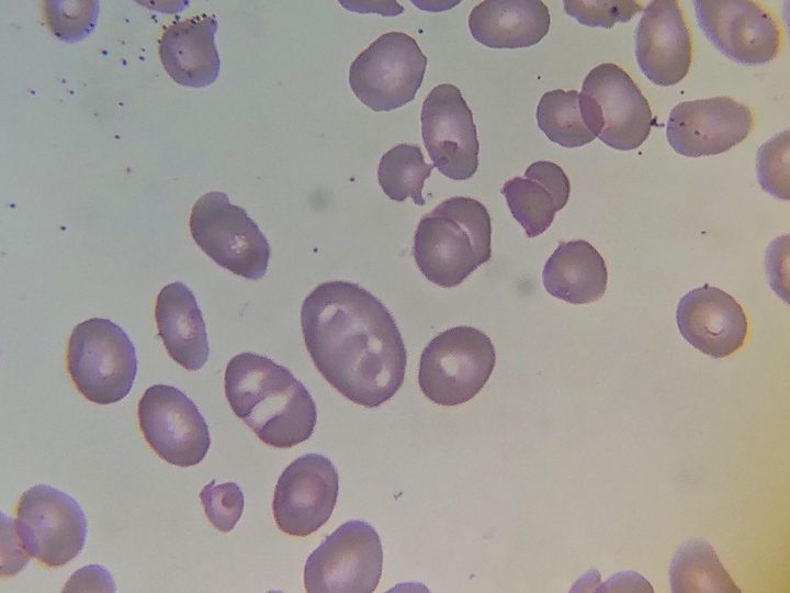 Blood smear: giant macro-ovalocyte and anisopoikilocytosis in B12 deficiency