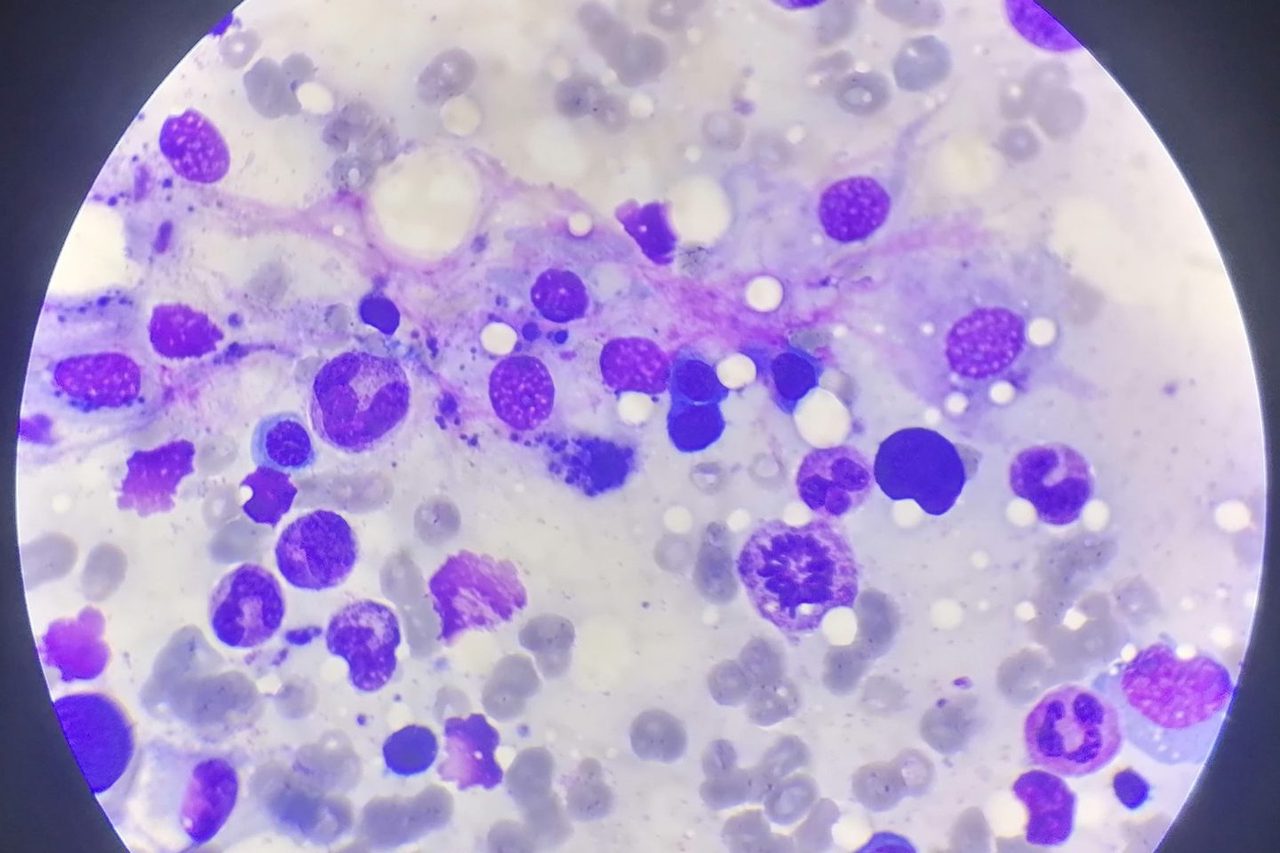 Macrophages and Emperipolesis in Bone Marrow Aspirate