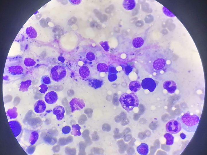 Bone marrow smear, cluster of macrophages with phagocytosed detritus