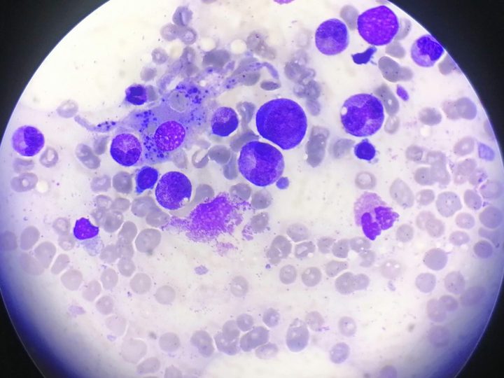Bone marrow smear, phagocytosing macrophage among myeloid cells