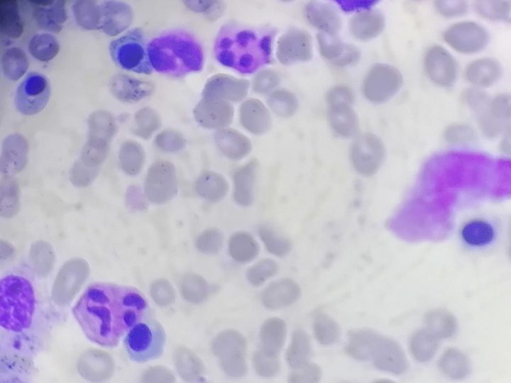 Bone marrow smear, macrophage with phagocytosed material in cytoplasm