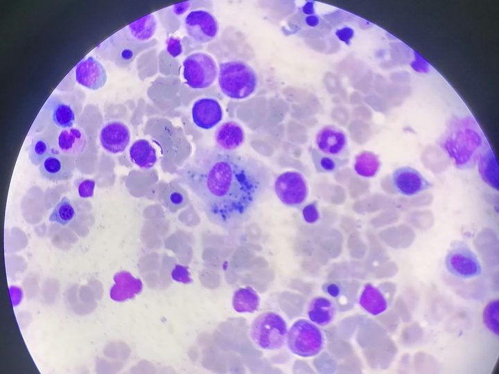 Bone marrow smear, single macrophage with phagocytic inclusions