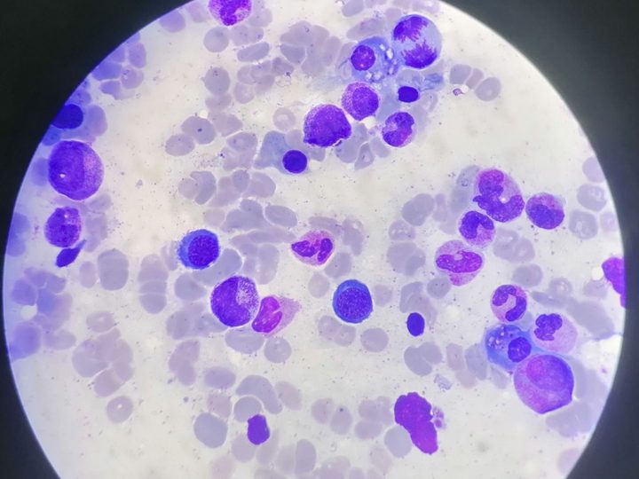 Bone marrow smear, plasma cells with inclusions and mitotic figure