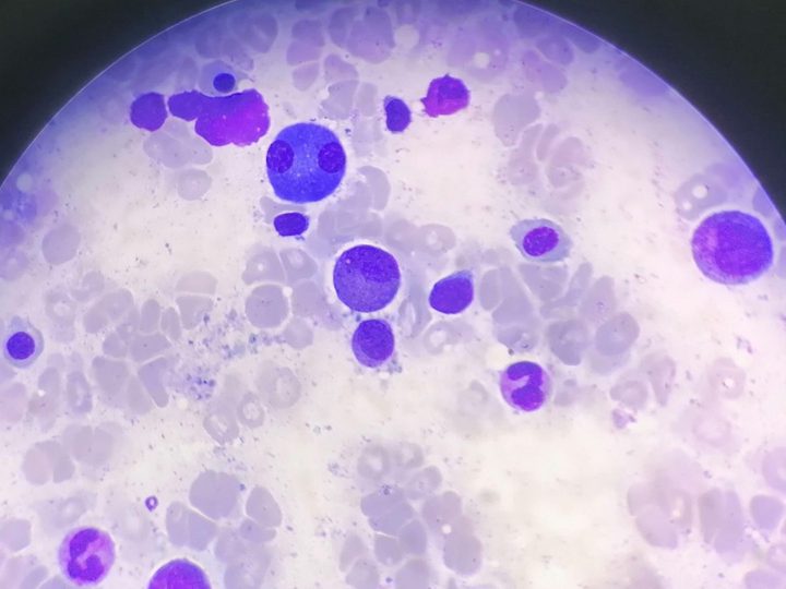 Bone marrow smear, binucleated plasma cell in the preparation