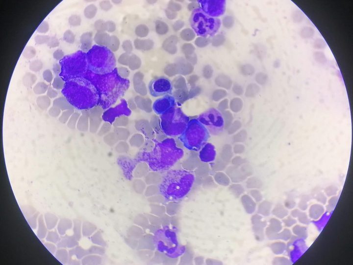 Bone marrow smear, hypersegmented neutrophil with Barr body