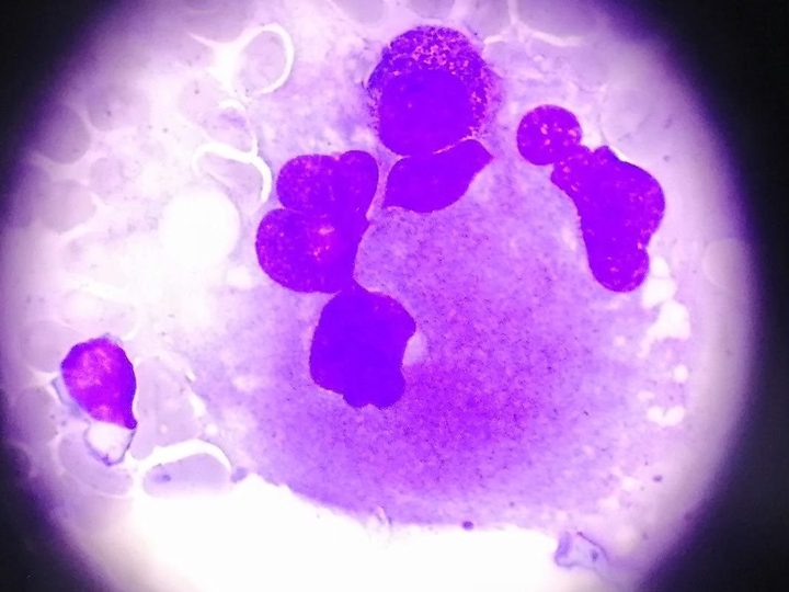 Bone marrow smear, mature megakaryocyte with emperipolesis phenomenon