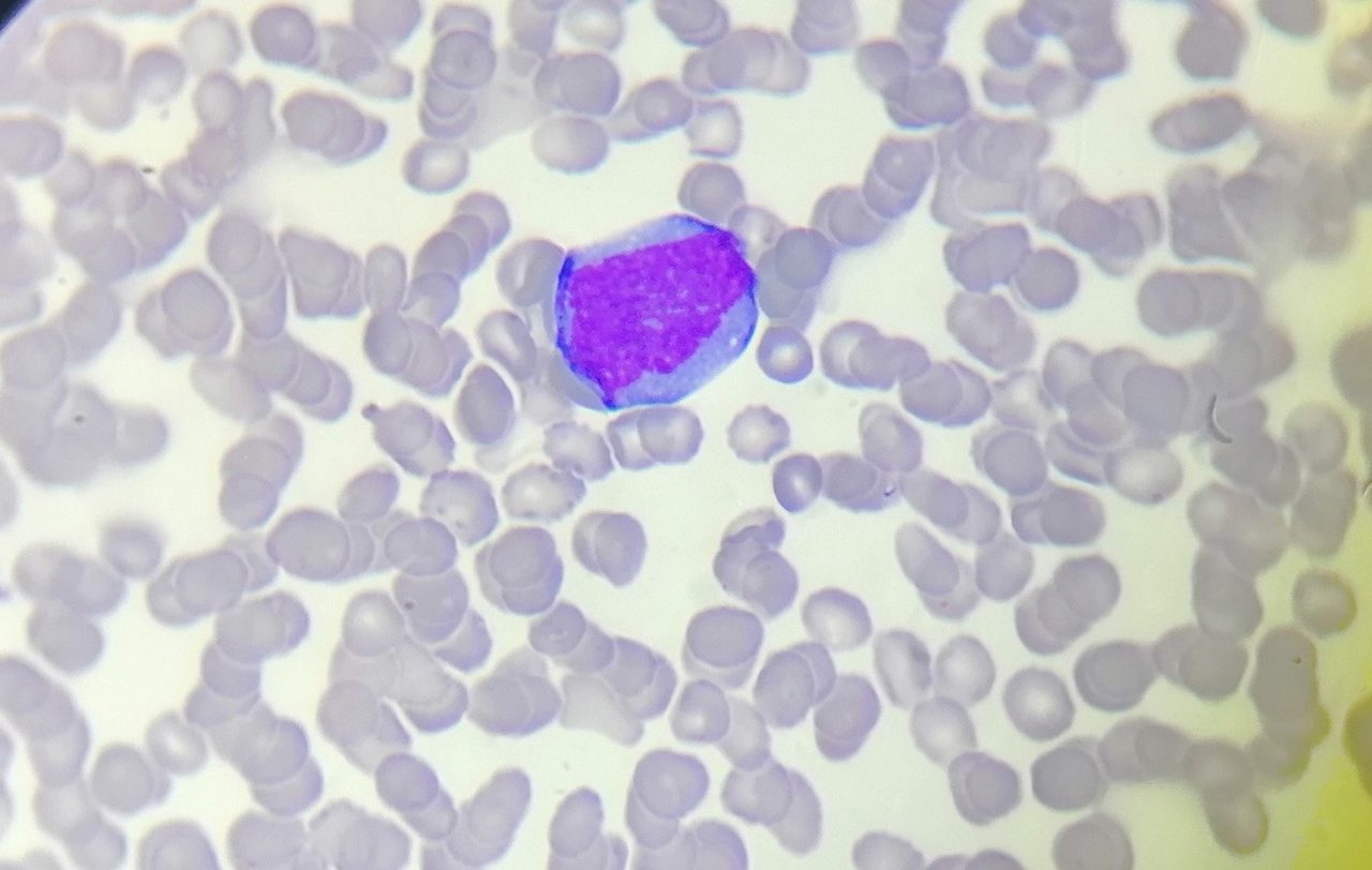 Waldenström Macroglobulinemia: Bone Marrow Cytology