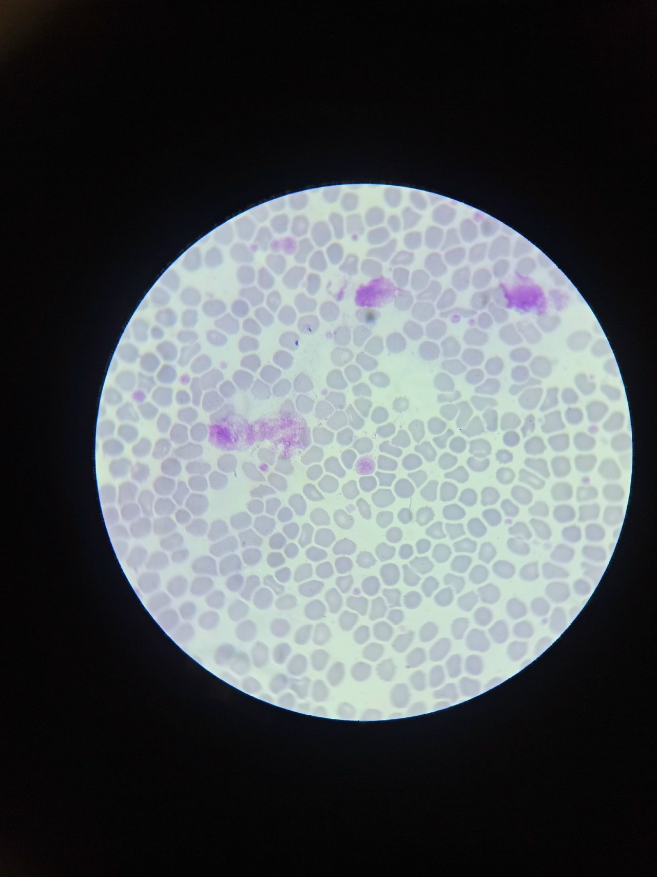 Macrothrombocytes and Giant Platelets in Blood Smear
