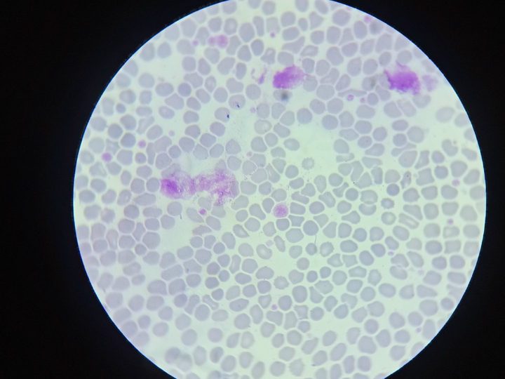 Peripheral blood smear, clusters of macrothrombocytes and disrupted cells